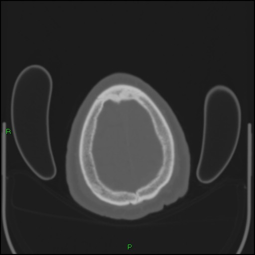 File:Cerebral contusions (Radiopaedia 33868-35039 Axial bone window 203).jpg