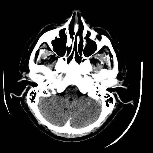 Cerebral edema (evolution in time) (Radiopaedia 19418-19440 non-contrast 20).jpg
