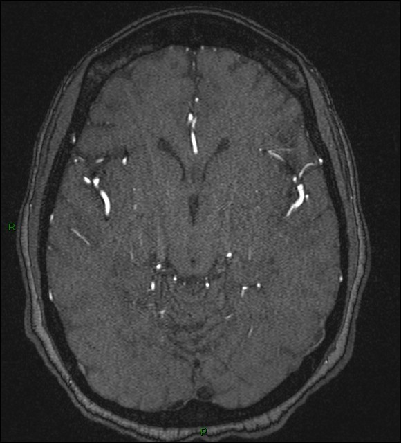 Cerebral fat embolism (Radiopaedia 35022-36525 Axial TOF 92).jpg