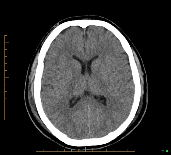Cerebral fat embolism (Radiopaedia 85521-101224 Axial non-contrast 29).jpg
