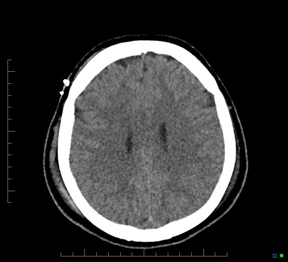 Cerebral fat embolism (Radiopaedia 85521-101224 Axial non-contrast 35).jpg