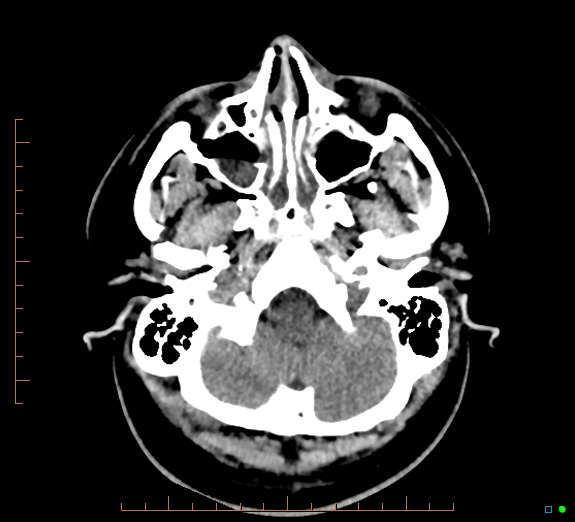 File:Cerebral fat embolism (Radiopaedia 85521-101224 Axial non-contrast 8).jpg