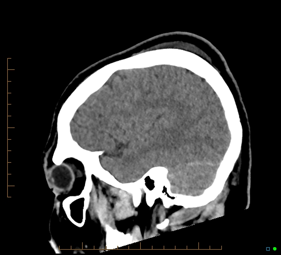 Cerebral fat embolism (Radiopaedia 85521-101224 C 13).jpg