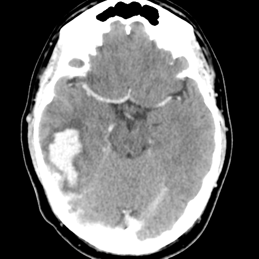Cerebral hemorrhage secondary to arteriovenous malformation (Radiopaedia 33497-34561 B 21).png