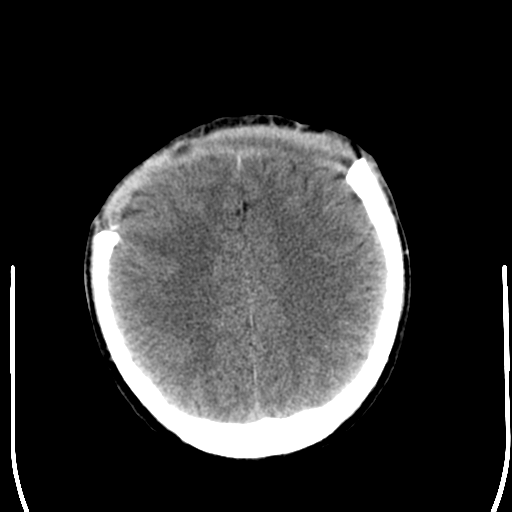 File:Cerebral hemorrhagic contusions- temporal evolution (Radiopaedia 40224-42756 Axial non-contrast 20).png