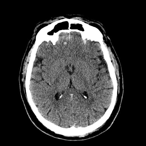 File:Cerebral hemorrhagic contusions and cervical spine fractures (Radiopaedia 32865-33841 Axial non-contrast 19).jpg