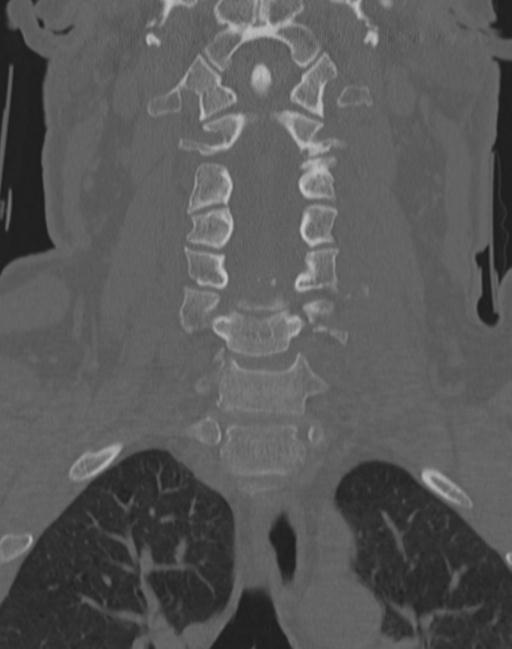Cerebral hemorrhagic contusions and cervical spine fractures (Radiopaedia 32865-33841 Coronal bone window 31).jpg