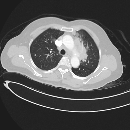 Cerebral metastases (Radiopaedia 33041-34055 Axial lung window 19).png