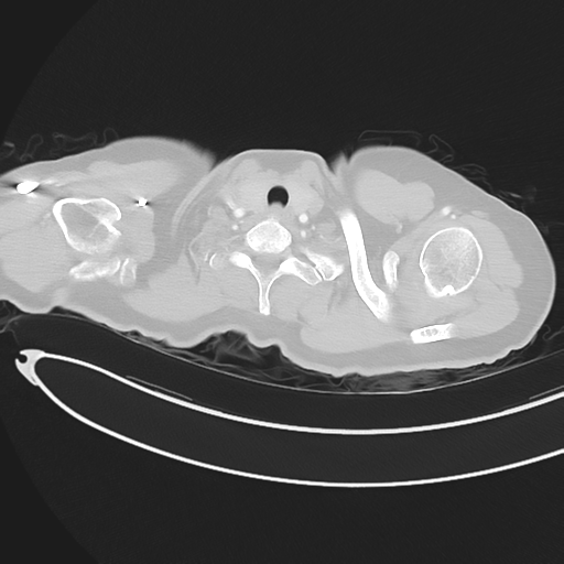 Cerebral metastases (Radiopaedia 33041-34055 Axial lung window 4).png
