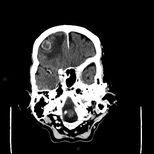Cerebral metastases - breast primary (Radiopaedia 77653-89857 Axial C+ delayed 27).jpg
