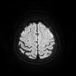Cerebral metastases - melanoma (Radiopaedia 80972-94522 Axial DWI 56).jpg