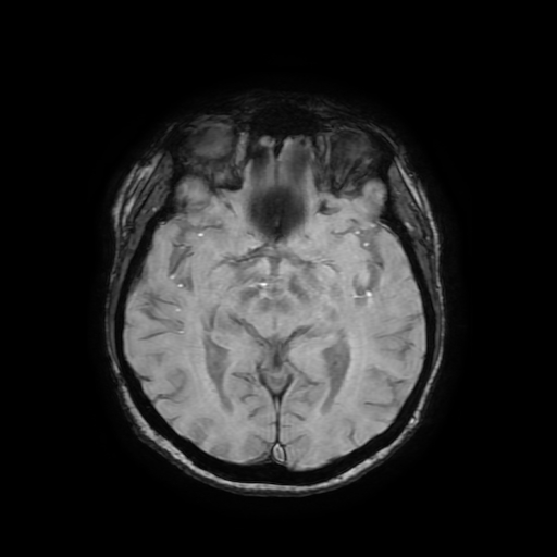 Cerebral metastases - melanoma (Radiopaedia 80972-94522 Axial SWI 46).jpg