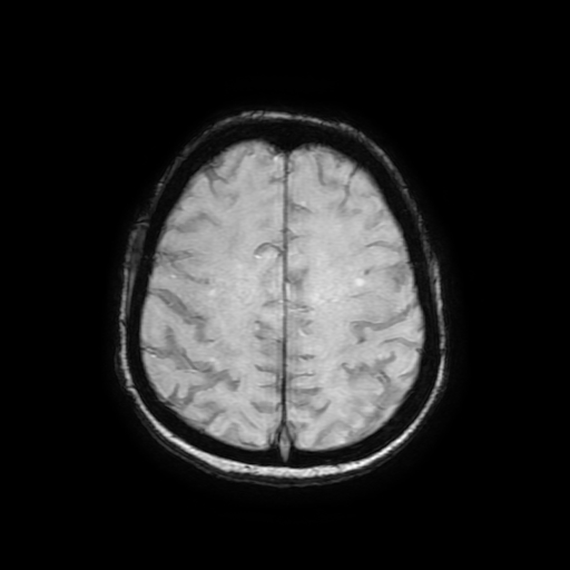 Cerebral metastases - melanoma (Radiopaedia 80972-94522 Axial SWI 74).jpg