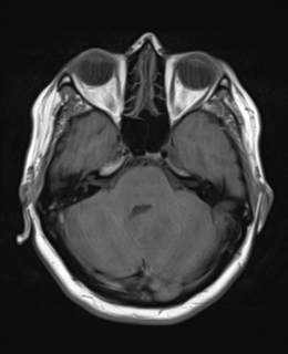 File:Cerebral metastases mimicking abscesses (Radiopaedia 45841-50131 Axial T1 9).png