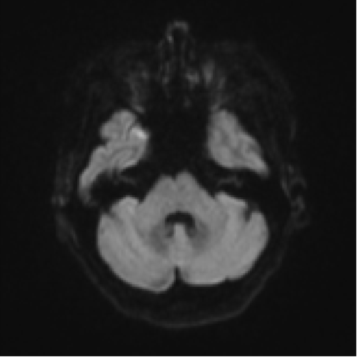 Cerebral metastasis (Radiopaedia 46744-51248 Axial DWI 35).png