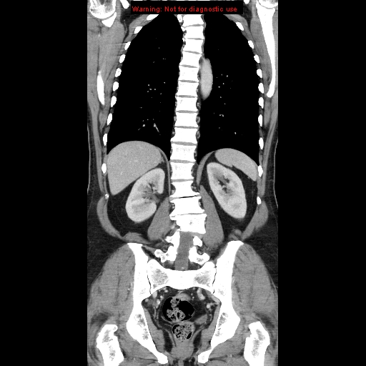 File:Cerebral metastasis - colorectal carcinoma (Radiopaedia 8581-83548 A 58).jpg