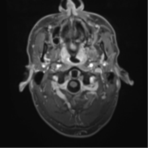 Cerebral metastasis - melanoma (Radiopaedia 54718-60954 Axial T1 C+ fat sat 3).png