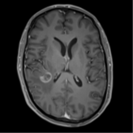 Cerebral metastasis - melanoma (Radiopaedia 54718-60954 Axial T1 C+ fat sat 30).png