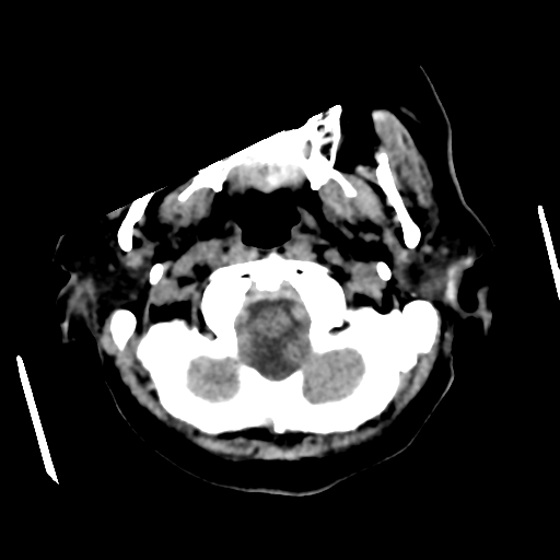 File:Cerebral metastasis to basal ganglia (Radiopaedia 81568-95412 Axial non-contrast 11).png