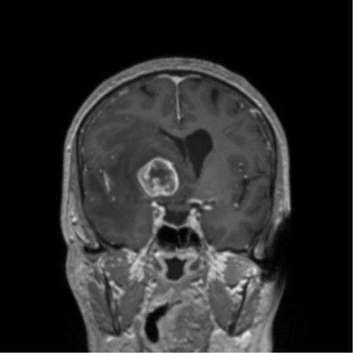 File:Cerebral metastasis to basal ganglia (Radiopaedia 81568-95413 Coronal T1 C+ 34).png