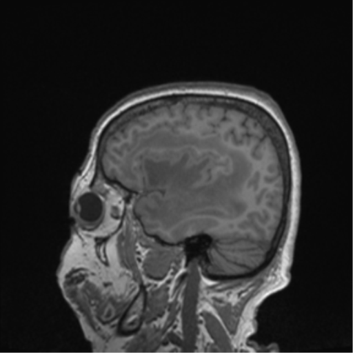 Cerebral metastasis to basal ganglia (Radiopaedia 81568-95413 Sagittal T1 60).png