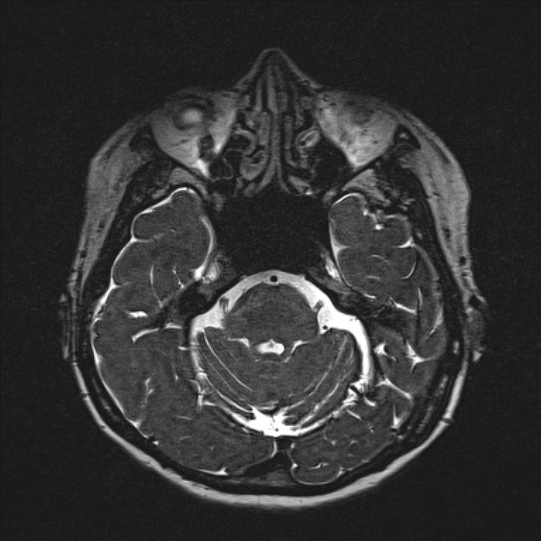 Cerebral ring enhancing lesions - cerebral metastases (Radiopaedia 44922-48817 F 47).jpg
