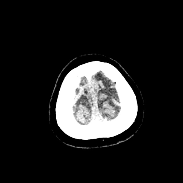 Cerebral ring enhancing lesions - cerebral metastases (Radiopaedia 44922-48818 Axial non-contrast 101).jpg