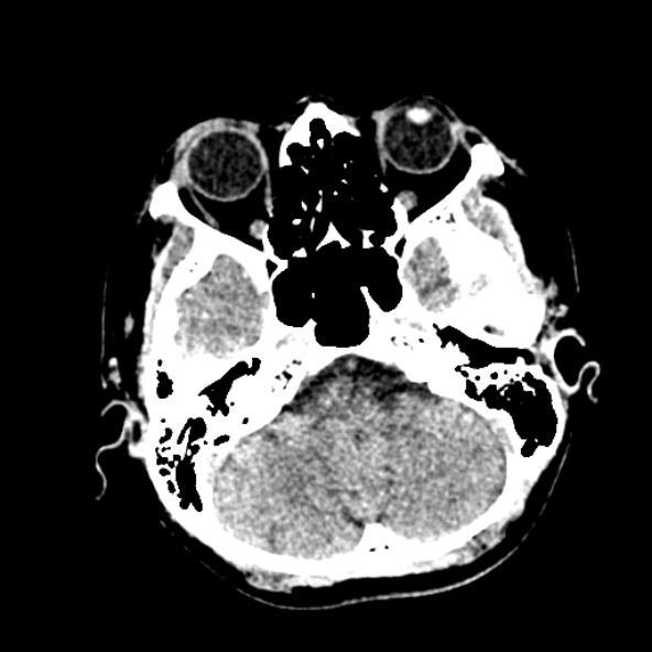 File:Cerebral ring enhancing lesions - cerebral metastases (Radiopaedia 44922-48818 Axial non-contrast 9).jpg