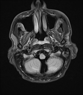 File:Cerebral toxoplasmosis (Radiopaedia 43956-47461 Axial FLAIR 2).jpg