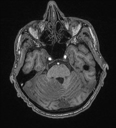 File:Cerebral toxoplasmosis (Radiopaedia 43956-47461 Axial T1 21).jpg