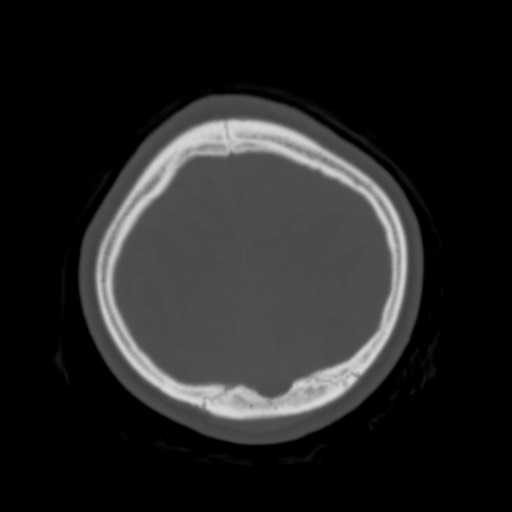 Cerebral tuberculosis with dural sinus invasion (Radiopaedia 60353-68018 Axial bone window 55).jpg