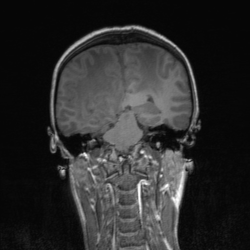 File:Cerebral tuberculosis with dural sinus invasion (Radiopaedia 60353-68090 Coronal T1 116).jpg