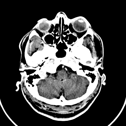 File:Cerebral venous angioma (Radiopaedia 69959-79977 B 1).jpg