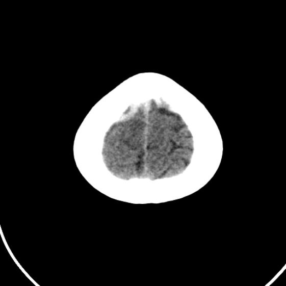 File:Cerebral venous hemorrhagic infarct from venous sinus thrombosis (Radiopaedia 55433-61879 Axial non-contrast 24).jpg