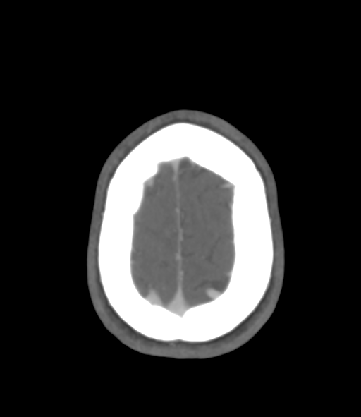 Cerebral venous hemorrhagic infarction (Radiopaedia 38461-40550 Axial MIP VENOGRAM 47).png