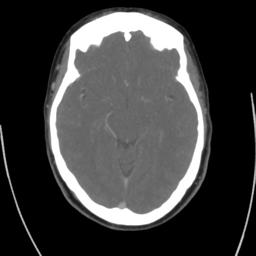 Cerebral venous infarct related to dural venous sinus thromboses (Radiopaedia 35292-36804 Axial C+ delayed 22).png