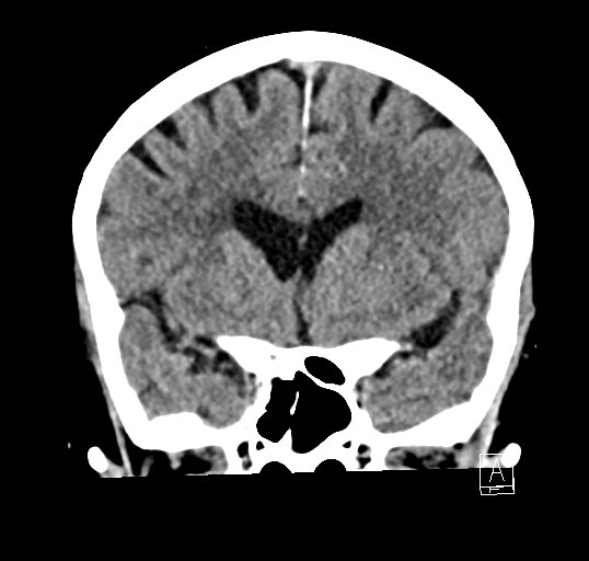 Cerebral venous infarction with hemorrhage (Radiopaedia 65343-74381 Coronal non-contrast 18).jpg