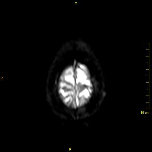 File:Cerebral venous thrombosis (Radiopaedia 23288-23351 Axial DWI 42).JPG