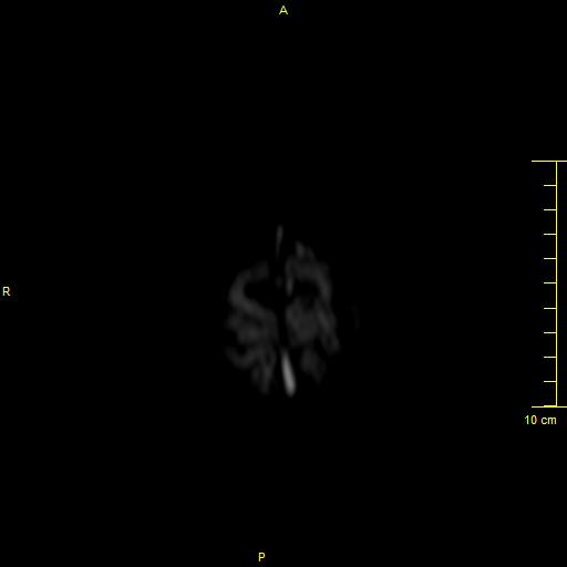 File:Cerebral venous thrombosis (Radiopaedia 23288-23351 Axial DWI 43).JPG