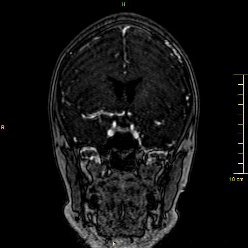 Cerebral venous thrombosis (Radiopaedia 23288-23351 MRV 48).JPG