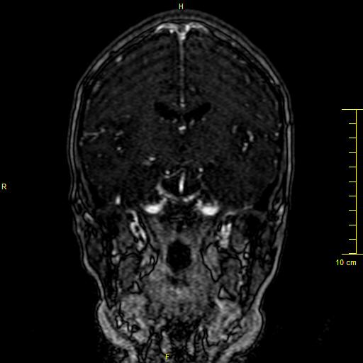 Cerebral venous thrombosis (Radiopaedia 23288-23351 MRV 72).JPG