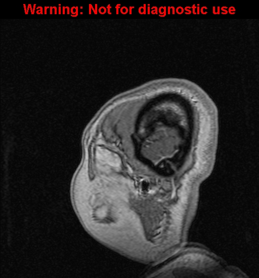 Cerebral venous thrombosis (Radiopaedia 37224-39208 Sagittal T1 C+ 11).jpg