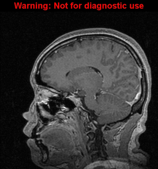 Cerebral venous thrombosis (Radiopaedia 37224-39208 Sagittal T1 C+ 89).jpg