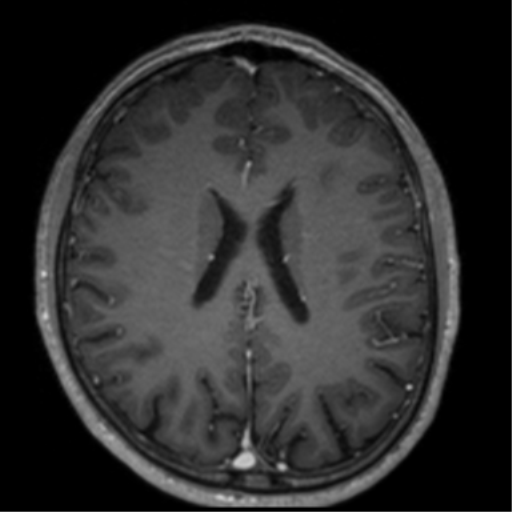 Cerebral venous thrombosis (Radiopaedia 38392-40469 Axial T1 C+ 50).png