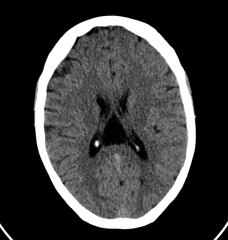 Cerebral venous thrombosis - CT only (Radiopaedia 41031-43778 Axial non-contrast 34).jpg