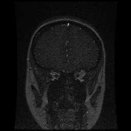 Cerebral venous thrombosis - ulcerative colitis (Radiopaedia 66049-75219 Coronal MRV 89).jpg