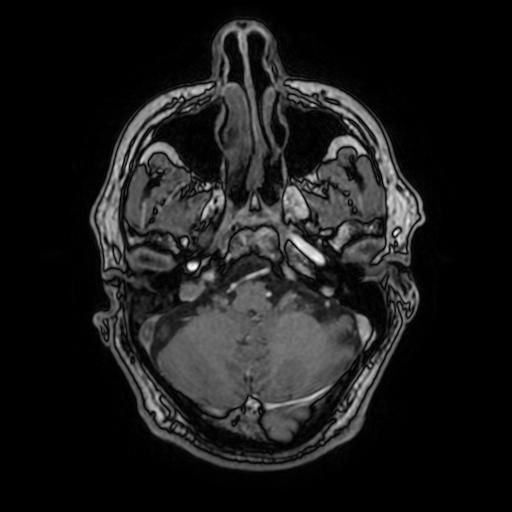 File:Cerebral venous thrombosis with secondary intracranial hypertension (Radiopaedia 89842-106957 Axial T1 C+ 50).jpg