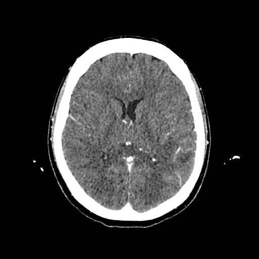 Cerebral venous thrombosis with venous hemorrhagic infarct (Radiopaedia 90354-107660 Axial with contrast 93).jpg