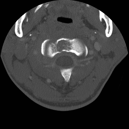 Cervical Pott disease (Radiopaedia 20374-20286 Axial bone window 32).jpg