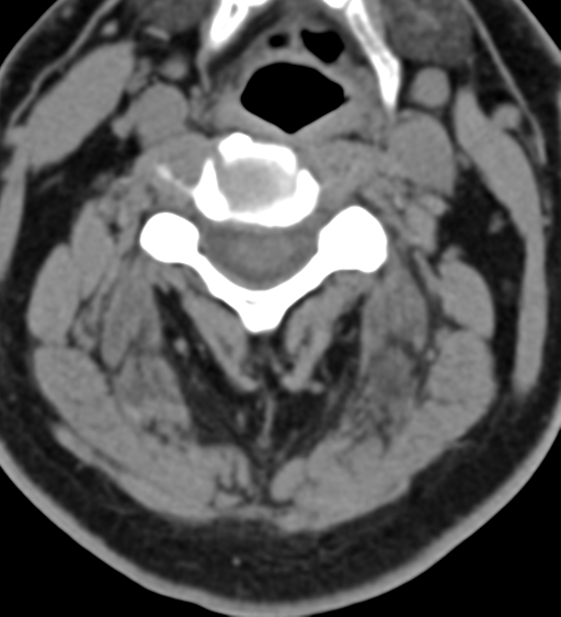 Cervical canal stenosis due to ossification of the posterior longitudinal ligament (Radiopaedia 47260-51823 Axial non-contrast 27).png